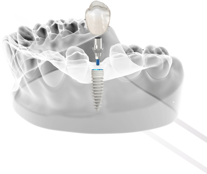 Cortex Dental Implants