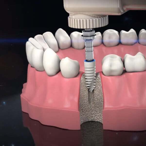 Tooth Drilling Procedures | Case Studies | Cortex - Dental